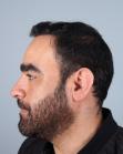After Hair Transplant&nbsp;2 Sessions (Areas)